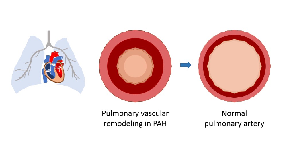 Behandlung der pulmonalen arteriellen Hypertonie (PAH)