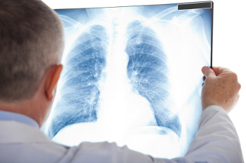 Wirkstoffe zur Behandlung der Lunge bei Idiopathischer Pulmonaler Fibrose (IPF)